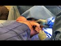 breast implant exchange breast augmentation redo at azul plastic surgery sugar land houston tx