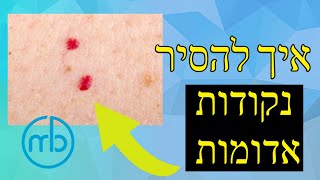 הסרת נקודות אדומות אנגיומות עם לייזר לצמיתות