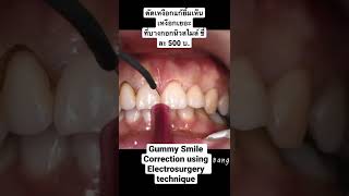 ตัดเหงือกแก้เหงือกเยอะ ด้วยเครื่อง Electrosurgery l #shorts