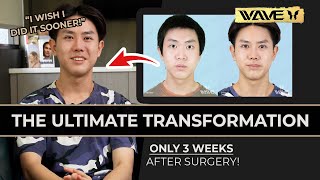 My Transformation: From Suture to Full Incision Double Eyelid Surgery | Wave Plastic Surgery