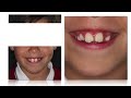 Tratamiento Ortodoncia Plástica Invisalign: Biprotrusión & Mordida Abierta