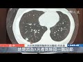 類風溼患者使用生物製劑 確診肺結核無典型症狀