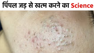 100% पिंपल खत्म करने का एक मात्र तरीका | एक्ने , पिंपल , दाग धब्बे , blackhead whiteheads