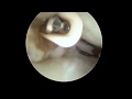 arthroscopic wrist dorsal rim synovectomy.mov