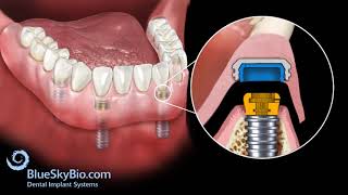 Implant Snap-In Dentures Procedure Explained