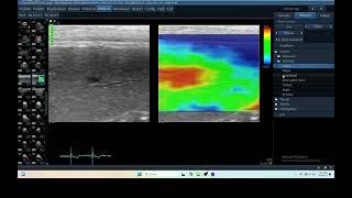 IQ 240 SPLEEN ELASTOGRAPHY GME ULTRASOUND ECHOPAC ANALYSIS