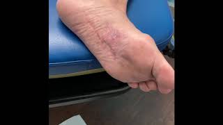 BEWARE OF PLANTAR FIBROMA SURGERY 😱😱😱😱