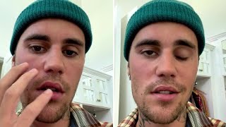 Justin Bieber🤕🤕💋Reveals His Face Is PARALYZED Selena Gomez, Taylor Swift Meet Him AT HOUSE TONIGHT'S