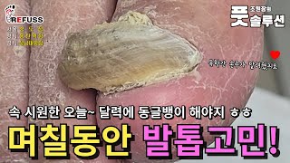 손주가 알려준 발톱관리! 막상 관리하려니 고민됐다는 어르신, 속시원한 관리로 해결했어요 #조원장의풋솔루션 #레푸스상도점 #레푸스동탄역점 #레푸스성남태평점 #문제성발톱 #refuss