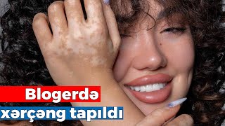 Tanınmış blogerdə xərçəng tapıldı