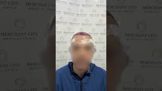 Hair Transplant Transformation: 3800 Grafts