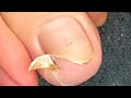 JUICY INFECTED INGROWN TOENAIL REMOVAL