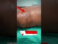 lipoma lipoma removal multipal lipoma removal short shortvideo