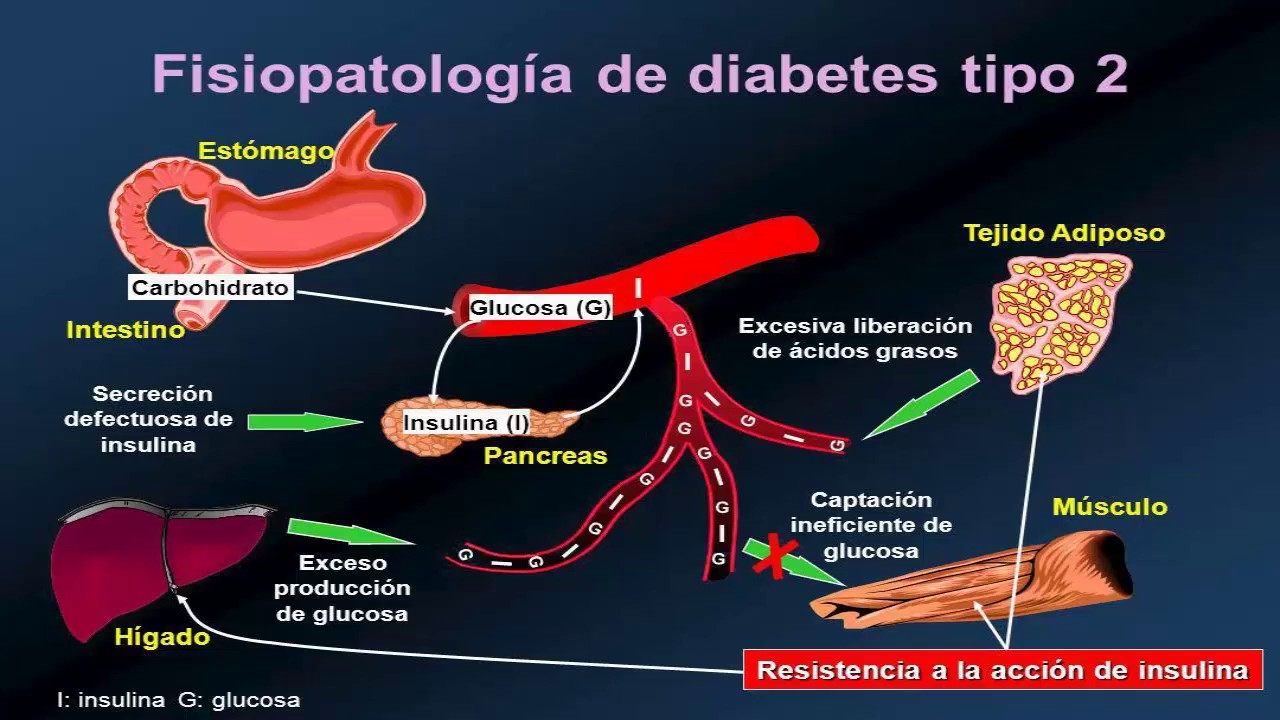 QUE ES LA DIABETES MELLITUS TIPO 2 - YouTube