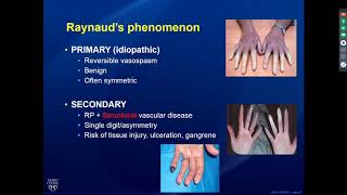 Rheumatology Pearls in Systemic Sclerosis  9/18/19