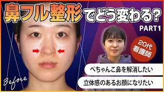 【ビフォーアフター】ぺちゃんこ鼻から卒業！20代女性が鼻整形を決意！術前インタビュー＆術後8日目のダウンタイムも大公開！【前半】