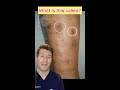 brown patches on the shins in a diabetic patient … what’s the diagnosis shorts medical diabetes