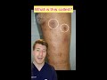 brown patches on the shins in a diabetic patient … what’s the diagnosis shorts medical diabetes