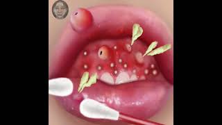 ASMR mouth anf eye infection treatment and satisfying cleaning##satisfying ##asmr