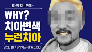 WHY? 치아변색, 누런치아의 원인과 해결방법!