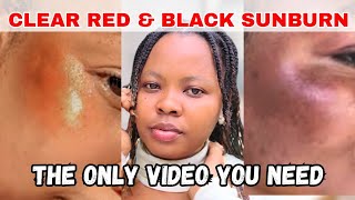 How To Get Rid Of Sunburn & Clear Dark Patches From Sunburn