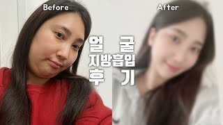 [얼굴지방흡입 1탄] 윤곽수술 없이 이 정도 브이라인 가능해?ㅋㅋ 광대살,볼살 빼고 이중턱까지 다 빼서.. 찐찐찐 행복하다구~😍 이중턱,네모얼굴 얼굴지흡으로 대.변.신!