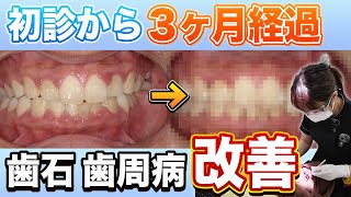 【初診から3か月の歯周病】ぶよぶよ歯茎が驚きの結果に！隠れ歯石をゴリゴリ除去🦷【ワイズ歯科矯正歯科＋KIDSイオン小牧店】