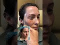 healing after trifecta lift with dr. kami parsa 6 days post op