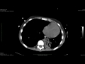 str cardiothoracic web case conference