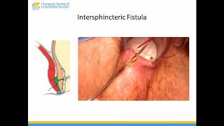 First Aid Toolkit for Anal Fistulas, a Detailed Treatise for Trainees (ESCP Trainee Video)