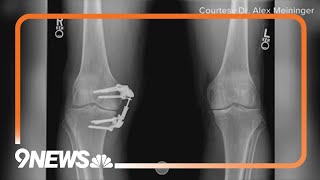 Doctor explains medical device that offers alternative to knee replacement