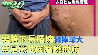 男胯下長腫塊如棒球大 竟是惡性肉瘤險截肢 健康2.0