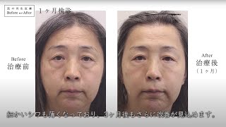 50代からの顔のたるみエイジングケア治療「肌の再生医療」61歳女性｜肌の再生医療ビフォーアフター｜治療開始～1ヶ月検診 ｜Part02