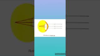 #Myopic eye and Myopic correction to Optical treatment