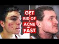 5 DO's & DON'TS To Get Rid of Acne FAST!