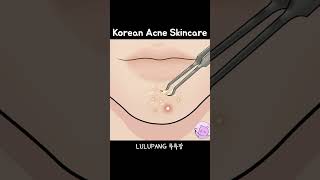 Satisfying Korean Acne Treatment 중독적인 여드름 케어 #asmr #skincare #pimplepoping