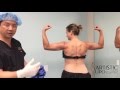 Celebrity Arms™ Liposuction | Lipedema Treatment | High -Definition Lipo 360 Arms | Expert Dr. Su