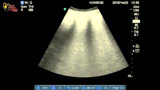 Obrzęk płuc w USG (obraz białego płuca)
