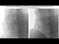 case 113 manual of cto interventions cto pci in prior tavr patient