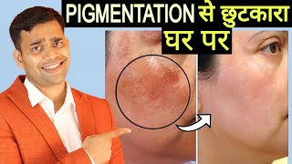 चहरे से झाइयां हटाने का सटीक तरीका | Treat Pigmentation, Melasma At Home - Dr. Vivek Joshi