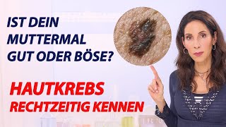 So erkennst Du Schwarzen Hautkrebs - Diese 5 Anzeichen musst Du wissen!  | Doktor Julie