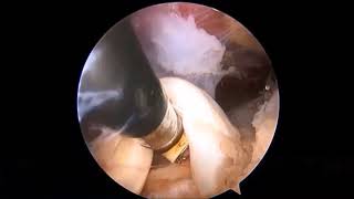 All-Arthroscopic Long Head of the Biceps Transfer...