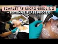 Watch Scarlet RF Microneedling & Fotona 4D Laser Treatment, Fotona LipLase With Me!