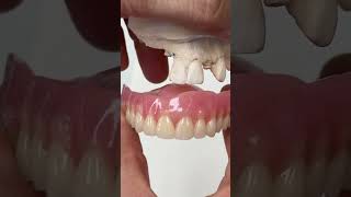 Replacing extracted teeth with a Brand-New Denture