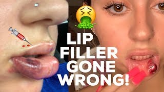 LIP FILLER GONE WRONG?!?