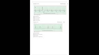 RELIAS DYSRHYTHMIA BASIC TEST 35 QUESTIONS AND ANSWERS 2023 BASIC A DYSRHYTHMIA REAL EXAM UPDATED AU