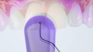 Simplify and Elevate: Neo Spectra ST® Effects Composite in Anterior Restorations