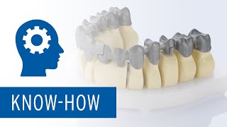 Ceramill Sintron - Großspannige Arbeiten mit Bridge Split