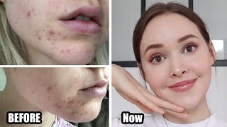 How To Really Get Rid Of Acne (& texture/acne scars/skin damage) *Adult Hormonal