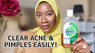 How to use DETTOL Antiseptic Liquid to clear acne| How to get rid of pimples with Dettol